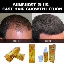 New Upgrade 100% Genuine Hair Growth Products Sunburst Plus Hair Growth Lotion 100ml for Fast Anti Hair Loss